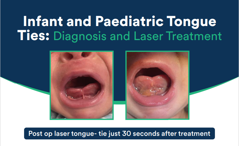 Paediatric Tongue Tie Treatment